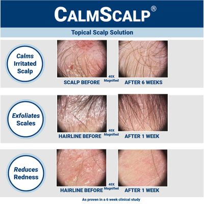 CalmScalp Topical Scalp Solution | Calms Irritated Scalp | Controls Dry Scalp &amp; Flakes | Reduces Scales &amp; Redness | Clinically Proven | Non Shampoo Leave-On Scalp Treatment | Made in The USA | 4 oz.