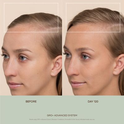 VEGAMOUR GRO+ Advanced Dermaroller | 1,200 Microneedle 0.25mm Scalp Tool | Gently Exfoliates the Scalp | Wide Head for Maximum Coverage