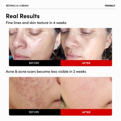 FRANKLY Retinol 0.3% Cream, 0.7 fl oz - Intensive Retinol Night Cream Retinol, Ceramides & Natural Ginseng Anti-aging, Wrinkles Care, Reduces Congestion and hyperpigmentation Korean Skin Care