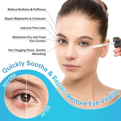 Eye Serum For Chalazion Blepharitis Treatment, 30ML Chalazion Remover For Eyelid Treatment, Blepharitis Eyelid Serum With Avocado Oil, Sea Buckthorn Oil Caffeine, Relieve Puffiness and Eye Fatigue