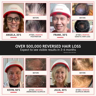 iRestore Professional Rechargeable Battery Pack - Laser Red Light Therapy for Hair Growth - FDA Cleared Hair Loss, Thinning Treatment for Men Women - Hair Regrowth Cap - 282 Lasers LEDs