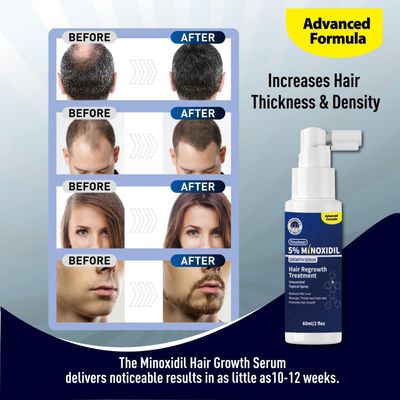 Yinoheer Minoxidil for Men 5 Minoxidil for Women Hair Growth, Hair Regrowth for Men Minoxidil 5 Percent for Thin Hair, Hair Loss Treatment to Regrow Fuller Thicker Hair, 2 Month Supply(2 bottle 2 oz)