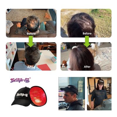 Instyle-Egg 280 Cap for Hair Regrowth, Low Level Laser Therapy System with Medical Grade Lasers for Scalp Treatment to Stop Hair Loss and Regrow Thinning Hair for MenWomen