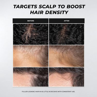 XMONDO Hair A3 Complex Scalp Foam for Hair Density Vegan Formula with Biollagen Amaranth, Fast-Acting Plant Actives For Amplified Volume Visibly Fuller, Healthier-Looking Hair, 3.38 Fl Oz