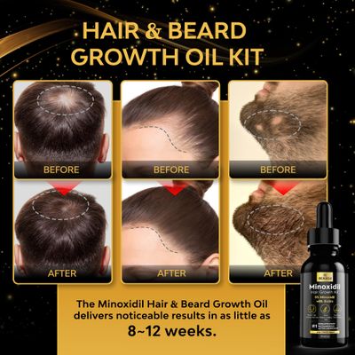 beaueli Minoxidil for Men Beard Growth Kit, Minoxidil for Women Hair Growth Kit, Hair Loss Treatments for Women Hair Regrowth Treatment, Minoxidil 5
