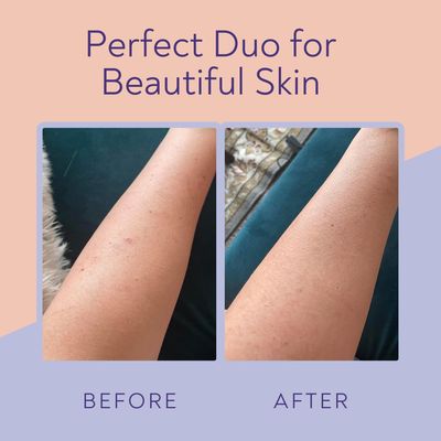 KP Bump Eraser Body Scrub &amp; Keratosis Pilaris Lotion Bundle Set - Strawberry Legs Treatment for Women - Exfoliates &amp; Deeply Hydrates for Smoother Healthy-Looking Skin