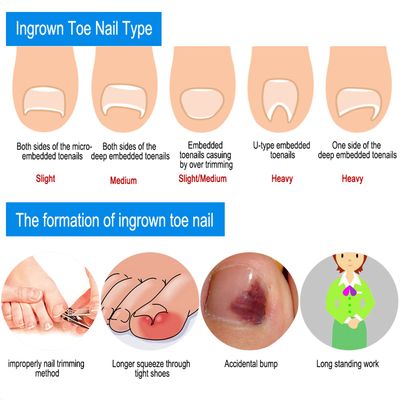 Ingrown Toenail Wire Corrector,Ingrown Toe Wire Fixer, 12Pcs Toenail Correction Tool 6 Sizes Corrector Correction Lifter Tool Brace for Nail Toe Straighteners Ingrown Wire Fixer Toe Nail Recover
