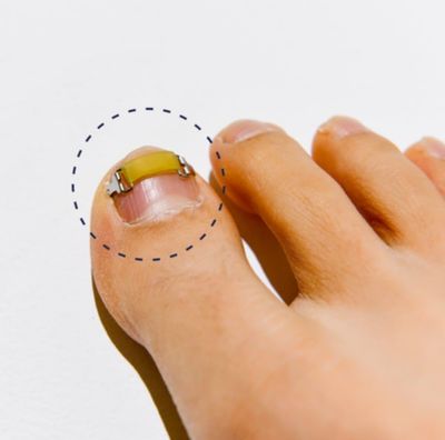 Generic XS0.63inches15-17mm Ingrown toenail treatment by latex ring elasticity, usable in everyday life, Ingrown toenail corrector, YellowSilver