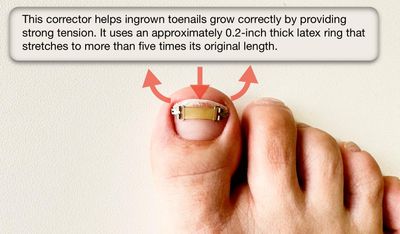 Generic XS0.63inches15-17mm Ingrown toenail treatment by latex ring elasticity, usable in everyday life, Ingrown toenail corrector, YellowSilver