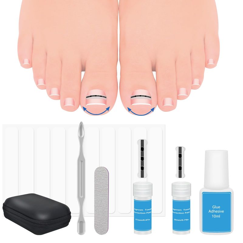 Upgraded ingrown toenail treatment, nail kit, Ingrown Toenail Treatment, Ingrown Toenail Removal Kit, Designed for Curved Nail Repair, Ingrown Toenail Corrector, Suitable for many types of correction.