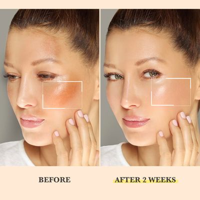Chemical Peel for Face - Peeling Oil for Facial &amp; Body Exfolianting with 16 Salicylic Acid - Dead Skin Remover with Gentle Formula for All Skin Type - 120 mL