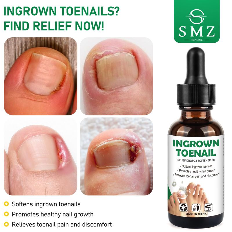 Ingrown Toenail Treatment: Ingrown Toenail Tool for Men Women - Ingrown Toenail Removal Kit - Ingrown Toenail Corrector Drops - Ingrown Toenail Remover - Effective Solution for Ingrown Toenails - 30ml