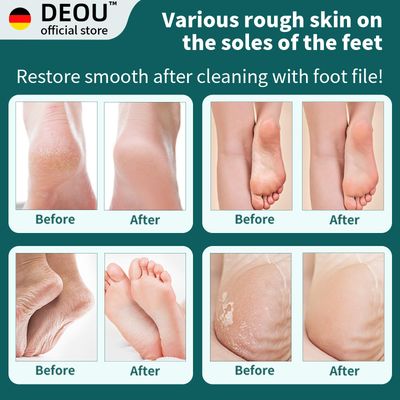 DEOU Metal Foot File SStainless Dead Skin Callus Remover for Dead Skin Professional Secure Foot Scrubber Heel Scraper Cracked Heels Repair Pedicure Tools for feet