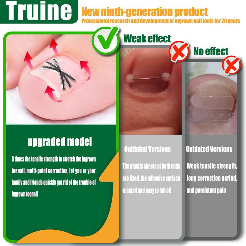 Truine Enhanced Titanium Ingrown Toenail Corrector, ingrown toenail treatmentSuitable for curved nailsingrown toenail removal kitat Home Ingrown Toenail TreatmentCurved Toenail Straightener