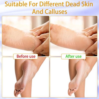 Whsdo Electric Callus Remover - 9 speeds, Foot Sander with Replacement Sandpaper Discs, Rechargeable Unisex Pedicure and Manicure Tool for Dead, Dry, chapped Skin and calluses