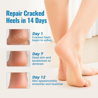 HOMEDSUN 2 Pairs Moisturizing Gel Toeless Socks for Dry Feet Cracked Heel Stick Repair Treatment Women Hydrating Foot Spa Moisture Softens Reusable Pedicure Sock