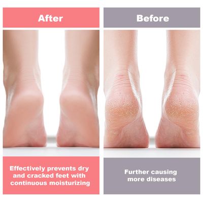 Vodolo 6 Pairs Silicone Socks for Dry Cracked Feet Women,New Upgrade Thickened Moisturizing Foot Mask Exfoliating Silicone Socks,Spa Gel Moisturizer Socks Foot Care After Pedicure