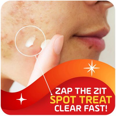 Asepxia Acne Treatment Cream for Face, 2 salicylic acid, Rapid Maximum Strength Acne Treatment, Clears Pimples and Blackheads, Prevents New Acne and Controls Excess Oil, 1 oz