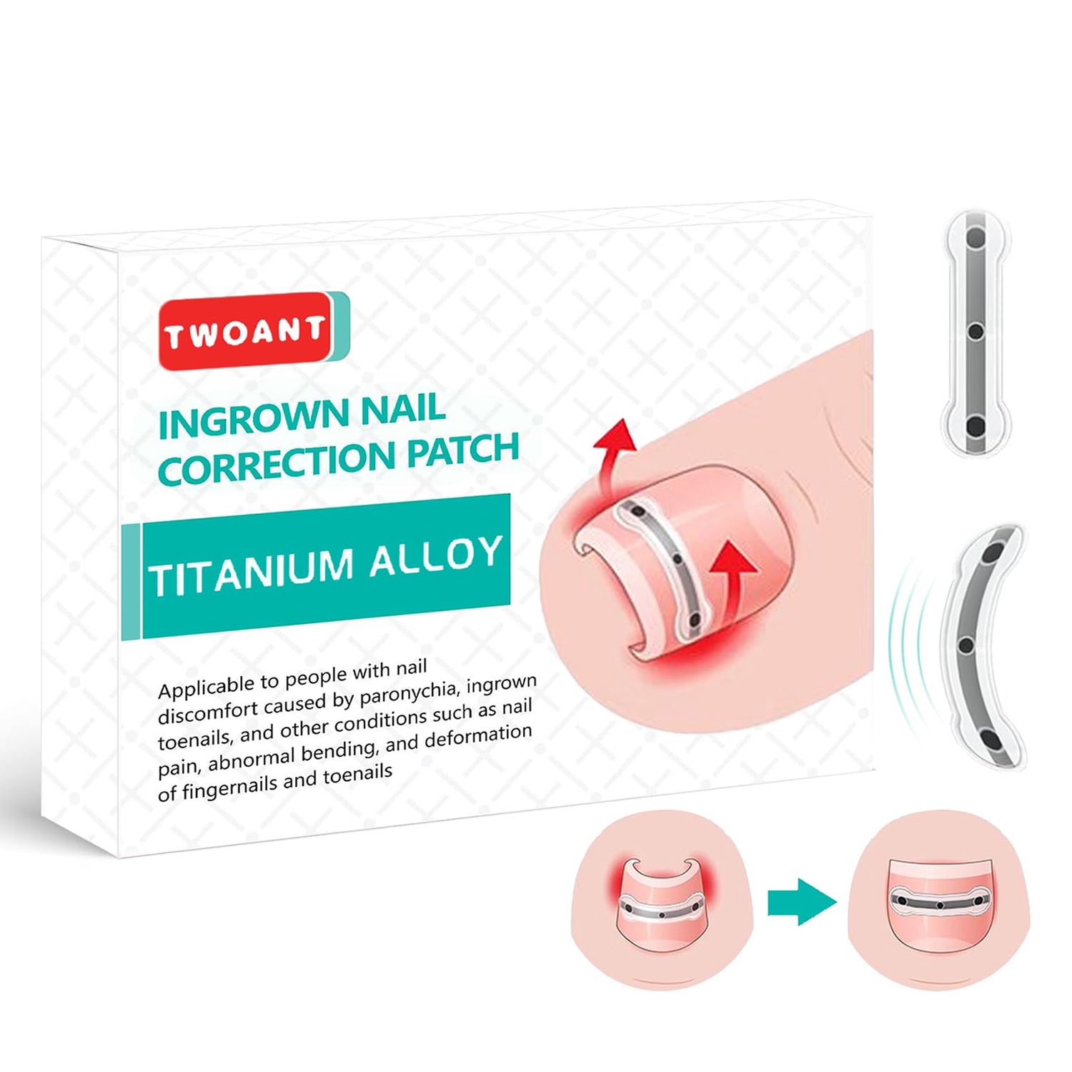 Titanium Alloy Ingrown Toenail Treatment, Ingrown Toenail Removal Kit, Big Toe Ingrown Nail Treatment Corrector, Designed for Curved Nail Repair, Applicable for Most Sizes (0.59/0.67/0.82in 9PCS)
