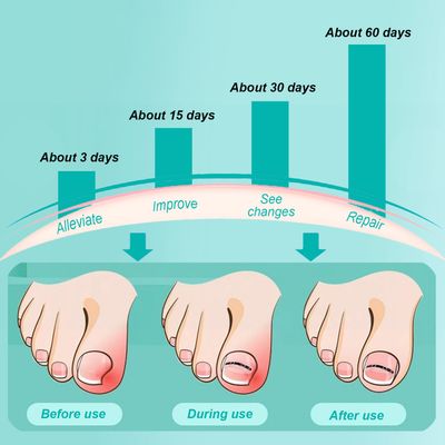 Titanium Alloy Ingrown Toenail Treatment, Ingrown Toenail Removal Kit, Big Toe Ingrown Nail Treatment Corrector, Designed for Curved Nail Repair, Applicable for Most Sizes (0.59/0.67/0.82in 9PCS)