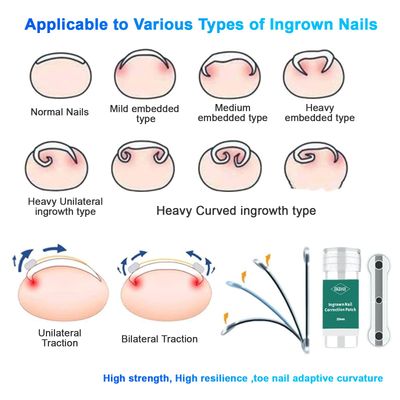 Titanium Alloy Ingrown Toenail Treatment, Ingrown Toenail Removal Kit for Curved Nail Repair, Nail Tools, Ingrown Nail Tool for Home Use (0.59/0.67in) SPYFAMILY 6