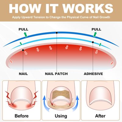 Ingrown Toenail Treatment, 50Pcs Breathable Corrector Patch, 30Pcs Ingrown Toenail Strips, Painless Ingrown Toenail Corrector Set with 2 Pedicure Tools, Not Easy to Fall Off