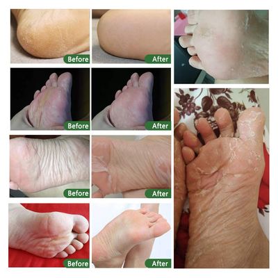 ALIVER Foot Peeling Mask - 5 Pack, Exfoliating Mask Make Feet Baby Soft, Foot Mask for Dry Cracked Skin, Peeling Away Dead Skin, Calluses - Lavender