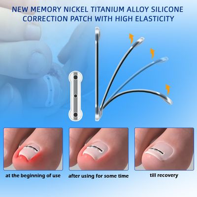 Truey Titanium Alloy Silicone Ingrown Toenail Treatment, correction patch, Ingrown Toenail Corrector, Nail correction tool,Ingrown Toenail Removal Kit,Cuttable Applicable for any nail size,Reusable