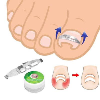 1pc Silver Ingrown Toenail Correction 17 to 22mm Adjustable Stainless Steel Toenail Corrector Pedicure Paronychia Correction Tool Nail Tools