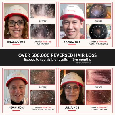 iRestore Professional Laser Red Light Therapy for Hair Growth System - FDA Cleared Hair Loss, Hair Thinning &amp; Alopecia Treatment for Men &amp; Women - Laser Cap for Hair Regrowth - 282 Lasers &amp; LEDs