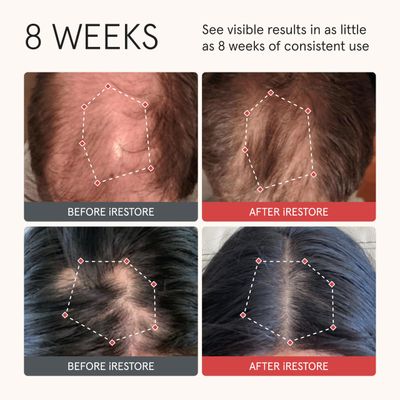 iRestore Anti Hair Loss and Thinning Shampoo - Biotin Formula for Hair Growth, Thickening and Volumizing for Men &amp; Women