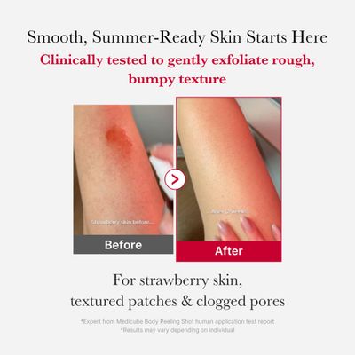 medicube Red Body Peeling Shot, AHA BHA Exfoliating Body Spray for Summer-Ready Smooth Skin, Treats Strawberry Skin, Bumps &amp; Breakouts, 3.88 oz