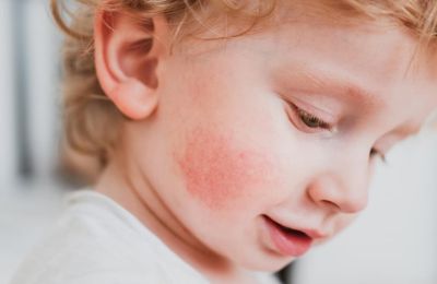 Allergische reactie bij kind
