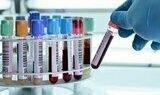 Urine Iodine