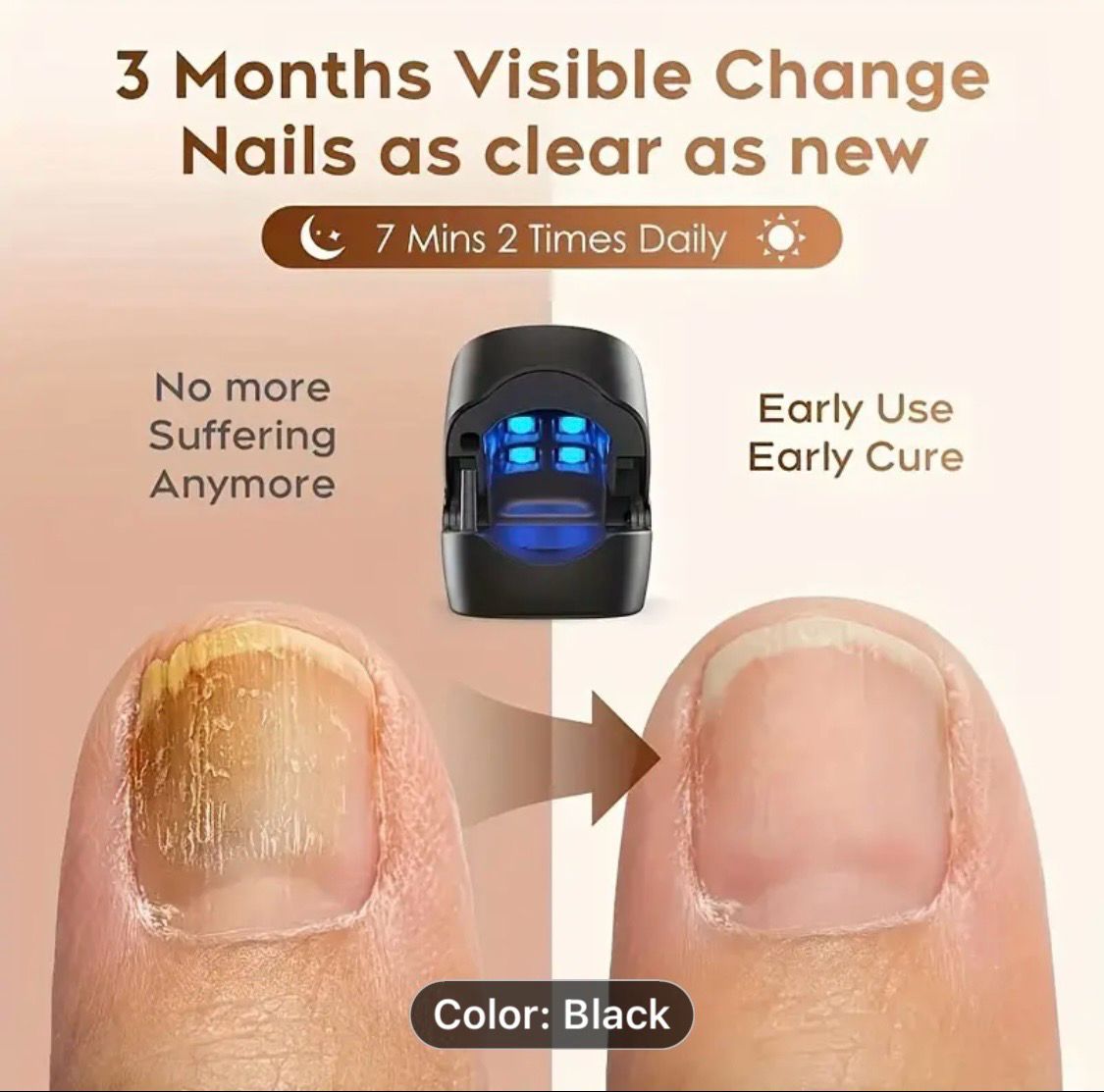 Nail Fungus Light Device, Nail Fungus Device For Fingernails And Toenails With Onychomycosis, Effectively For Damaged, Discolored And Thickened Nails, Suitable For Home Use