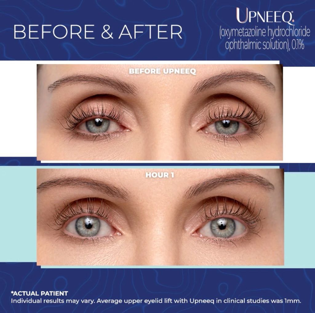UPNEEQ Eyelid Lifting Eye Drops - 10 Vials