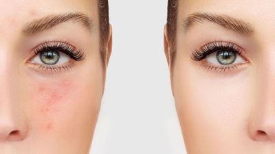 для проблемной и чувствительной кожи