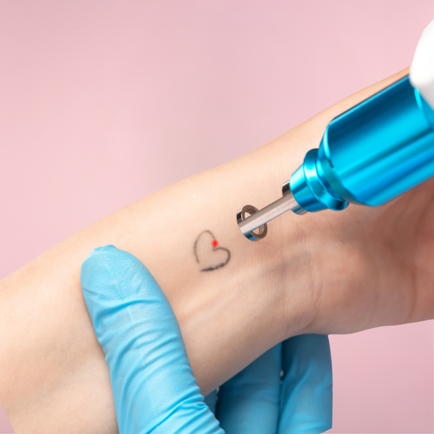 Laser Tattoo Removal