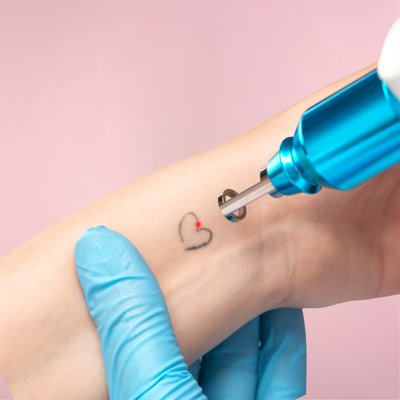 Laser Tattoo Removal