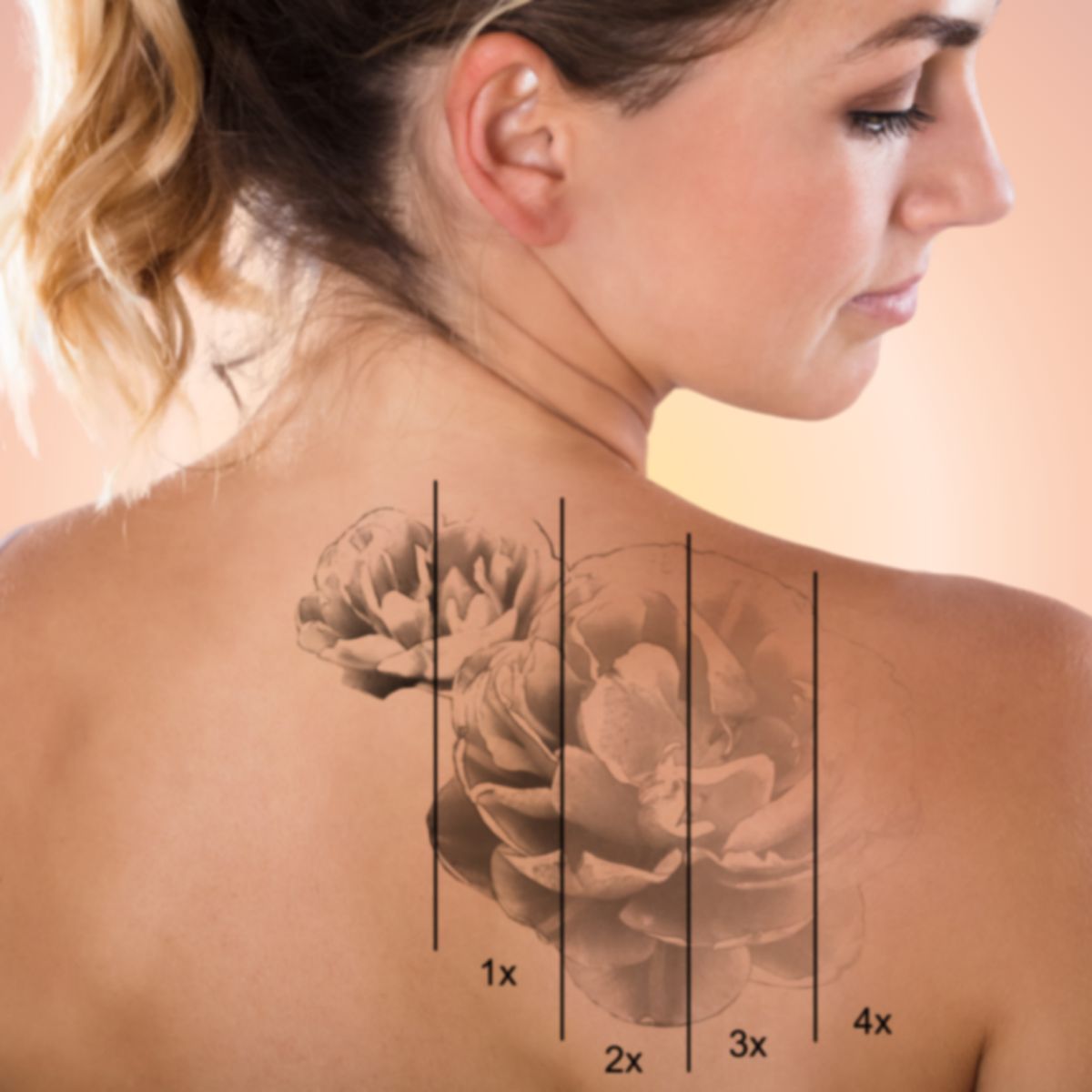 Laser Tattoo Removal – Safe &amp; Effective Fading for All Skin Types
