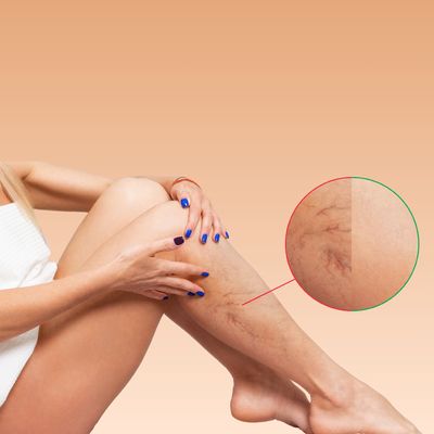 Laser Vein Removal