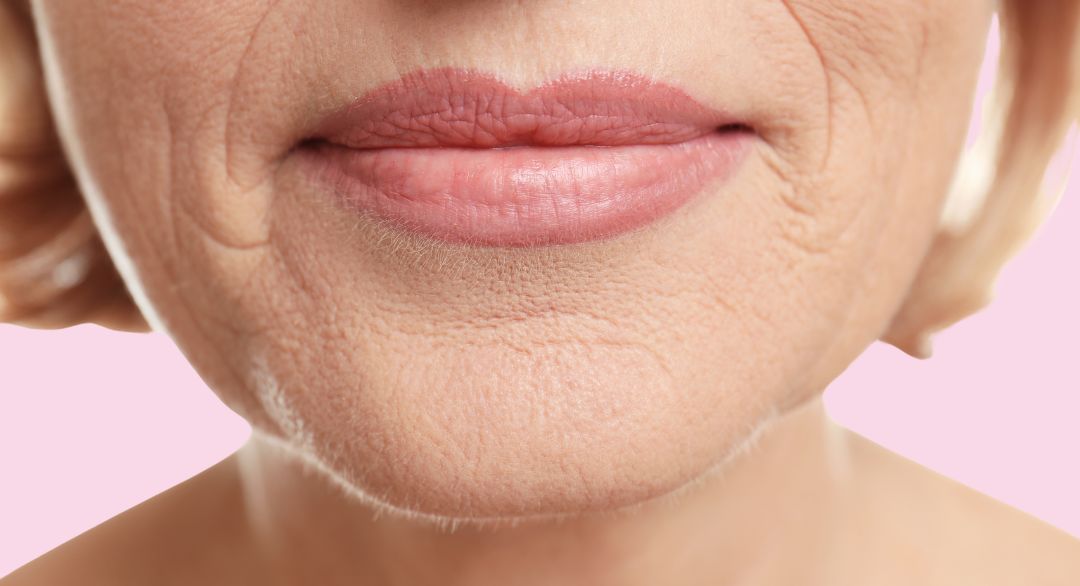 ✨ November Flash Sale — Limited Quantities! Juvederm® Volbella – Special