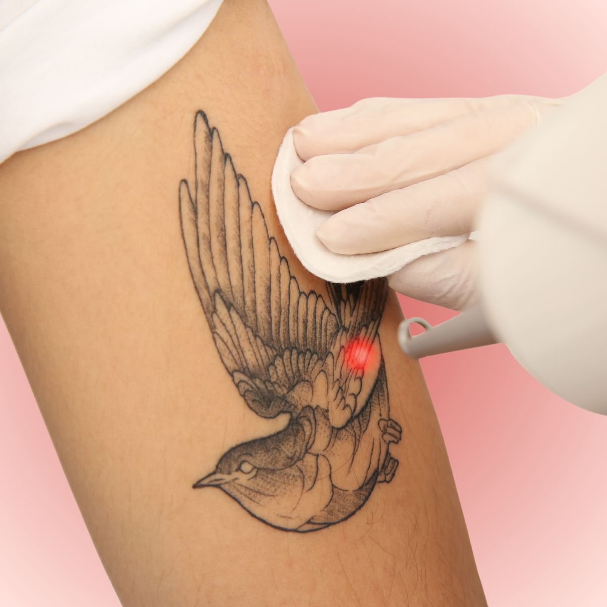 Laser Tattoo Removal