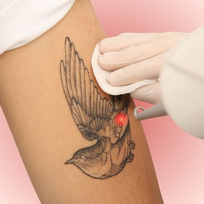 Laser Tattoo Removal Laser Tattoo Removal