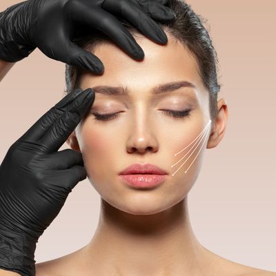 PDO Thread Lift – Non-Surgical Face &amp; Neck Lift