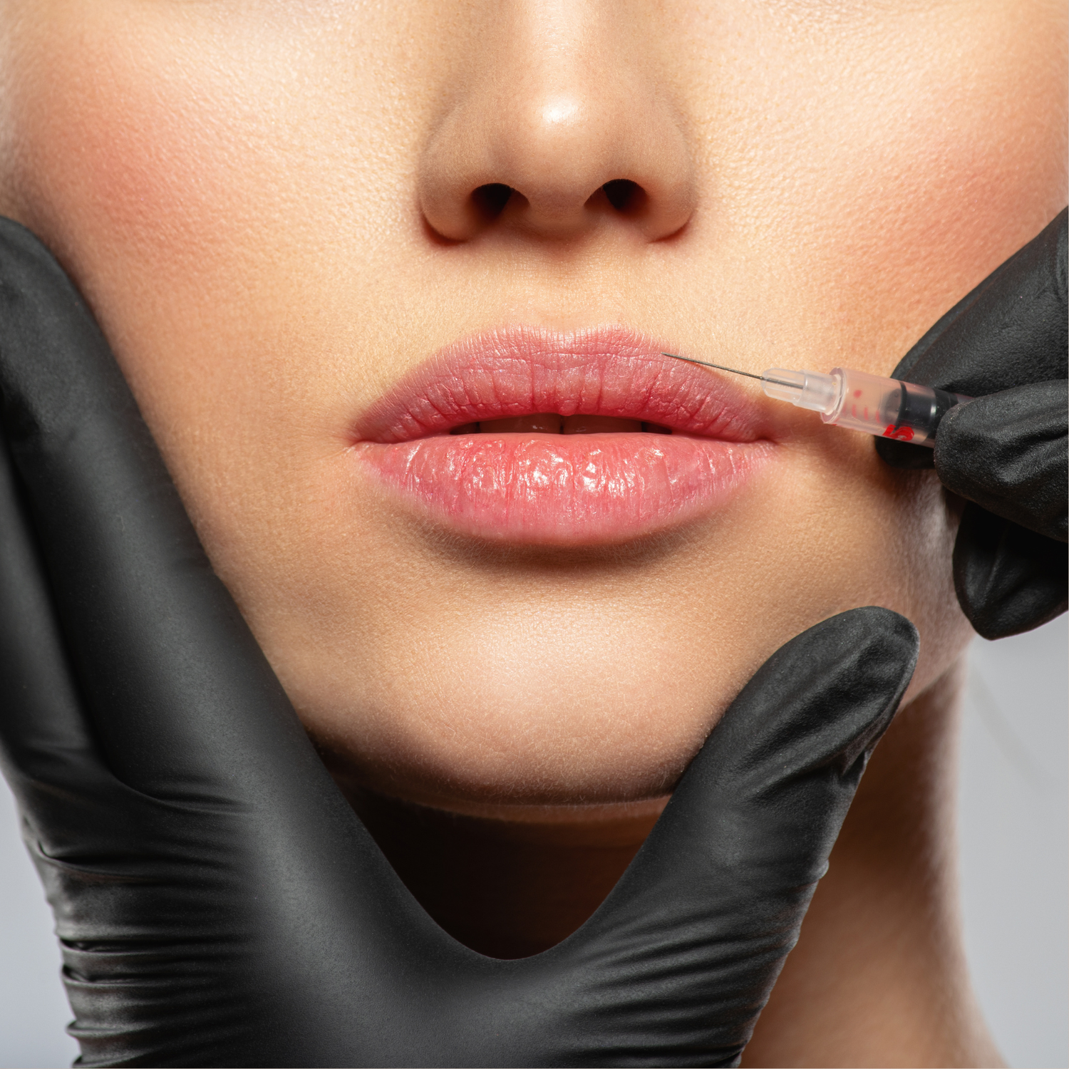 ✨ New Patient Special—Juvederm Ultra xc®
