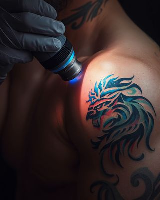 Laser Tattoo Removal – Safe &amp; Effective Fading for All Skin Types