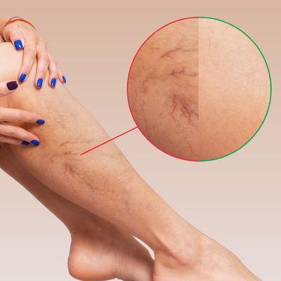 Laser Vein Removal