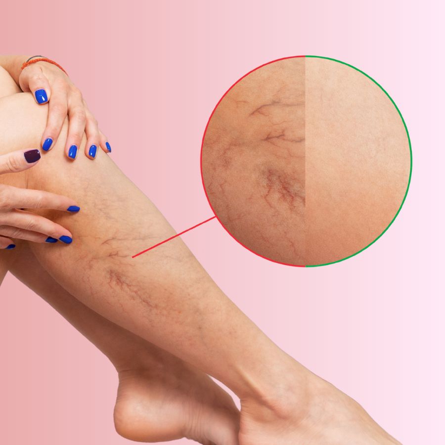 Laser Vein Removal