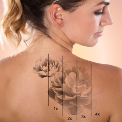 Laser Tattoo Removal